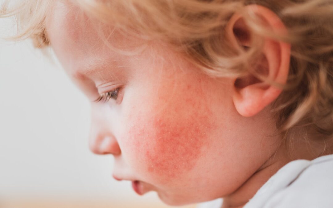 Szkarlatyna u dzieci: Objawy, przyczyny i leczenie